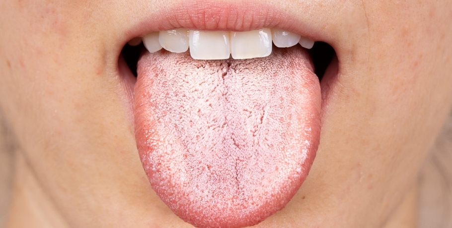 ¿Cuáles son los síntomas del sobrecrecimiento de Candida u otros hongos?